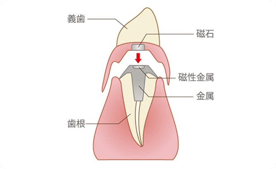 磁性アタッチメント画像