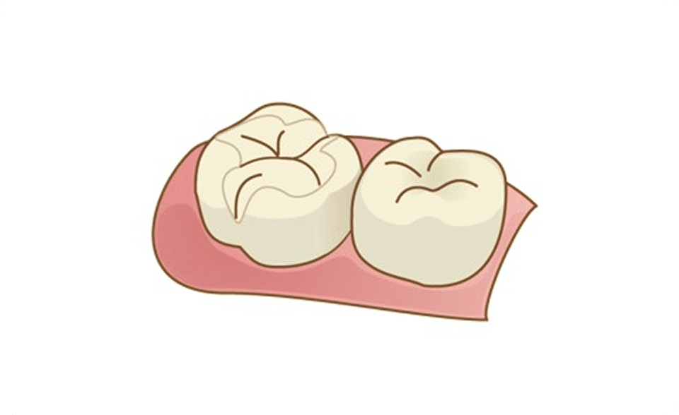 セラミックインレー画像